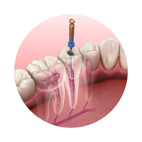 Kanal Tedavisi (Endodonti)