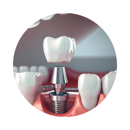 Dental İmplant Tedavisi